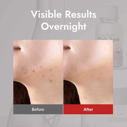 MIZON Pink Spot Overnight Spot Care Pimple Care Product, 19ml/0.65 fl oz