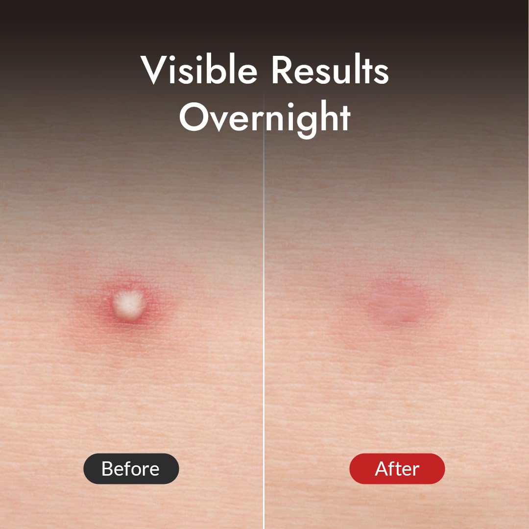 MIZON Good Bye Blemish Clear Patch Invisible Korean Acne Pimple Covering Zits Waterproof Non-drying Thin Cover Excellent Skin Adhesion Patch Spot Cover (44ea)